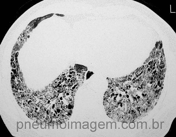 NOVAS DIRETRIZES PARA O TRATAMENTO DA FIBROSE PULMONAR IDIOP�TICA: LEIA AS PRINCIPAIS MUDAN�AS.
